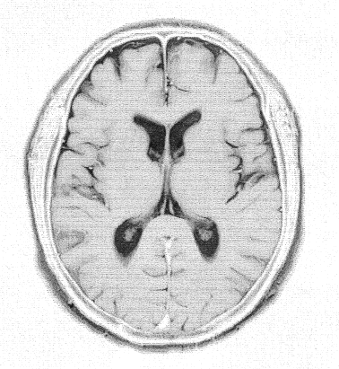 頭部MRI（磁気共鳴画像検査）の画像