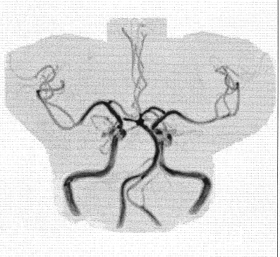 •頭部MRA（磁気共鳴血管画像検査）の画像